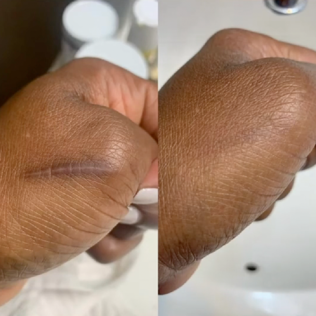 Scar Removal Sheets